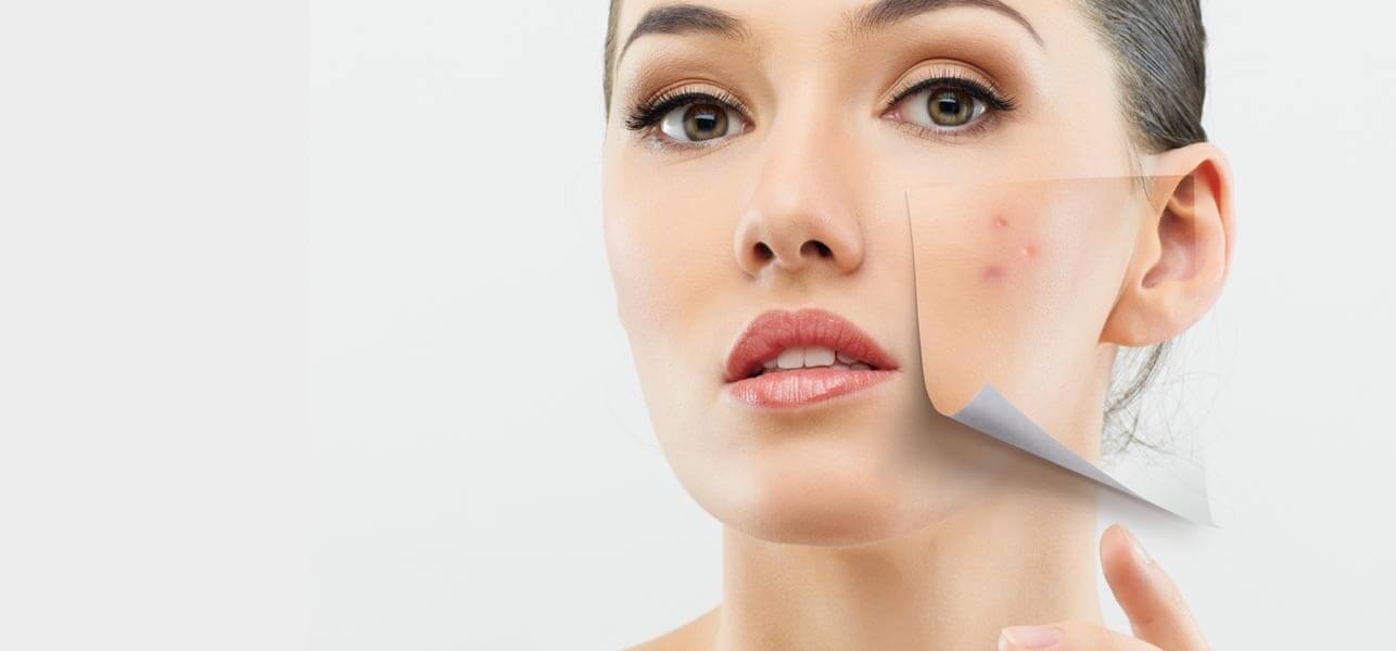 Solution to Pimples Solution to Pimples