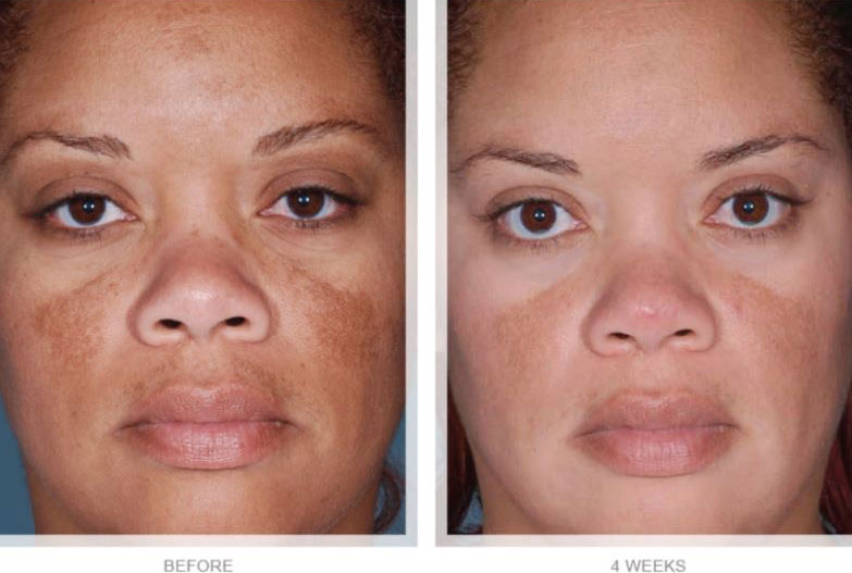 OBAGI-NUDERM-CLEAR-FX-&-NUDERM-BLEND-FX-BEFORE-AND-AFTER OBAGI-NUDERM-CLEAR-FX-&-NUDERM-BLEND-FX-BEFORE-AND-AFTER